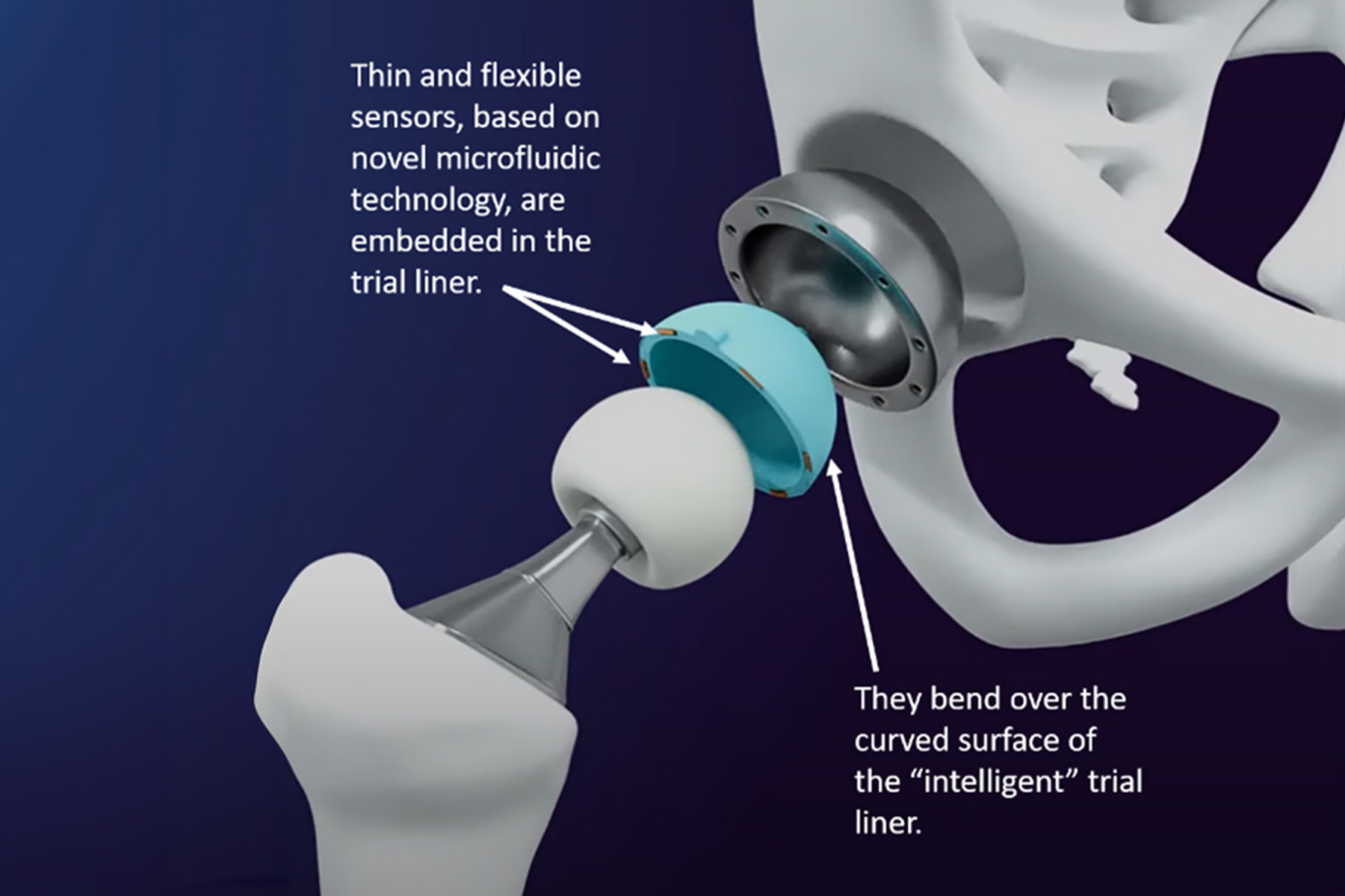 ArtioSense hip replacement surgery